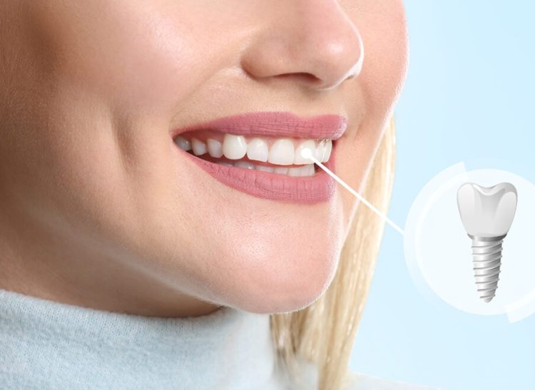 Young woman with implanted teeth on color background, closeup